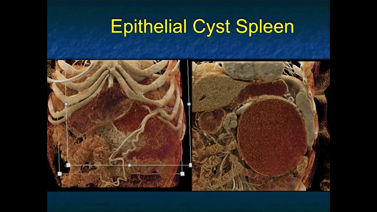 MDCT Evaluation of the Spleen: Challenges in Diagnosis - Part 3