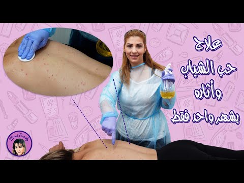 أسرع طريقة لعلاج حب الشباب وأثاره اصنعي التونر الخاص فيكي لتعقيم الجسم والوجه
