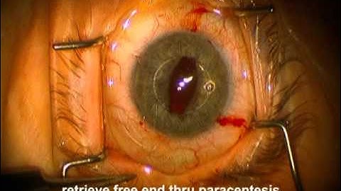 Chang Siepser IOL Fixation