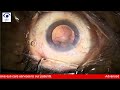 Live Cataract Surgery: ISOpure IOL Implantation | Dr. Gaurav Luthra