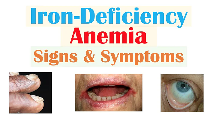 Unveiling the Signs of Iron-Deficiency Anemia: Fatigue, Spoon Nails, Cracked Lips