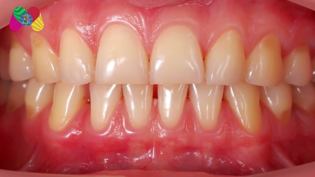 GINGIVITIS MEXICALTZINGO