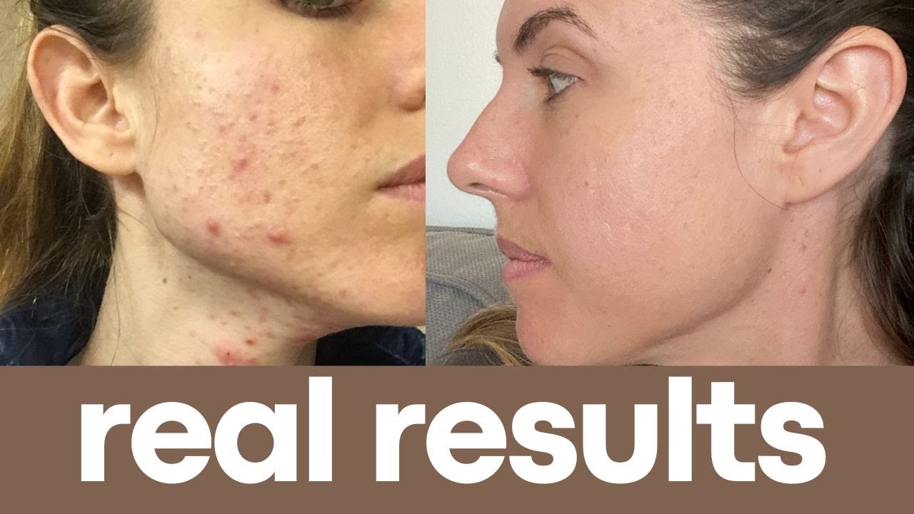 MY ACNE NIGHT TIME SKINCARE ROUTINE- ACNE SCARING AND CLEAR SKIN - YouTube