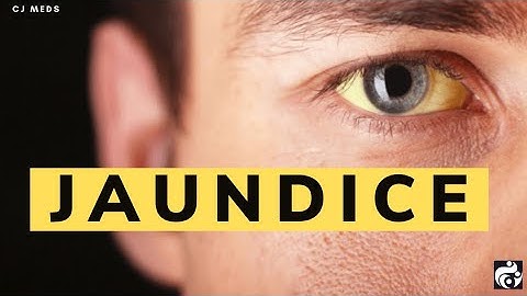 JAUNDICE | Types of Jaundice | Biochemical tests to investigate Jaundice || Cj Meds ||