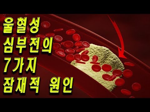 울혈성 심부전의 7가지 잠재적 원인