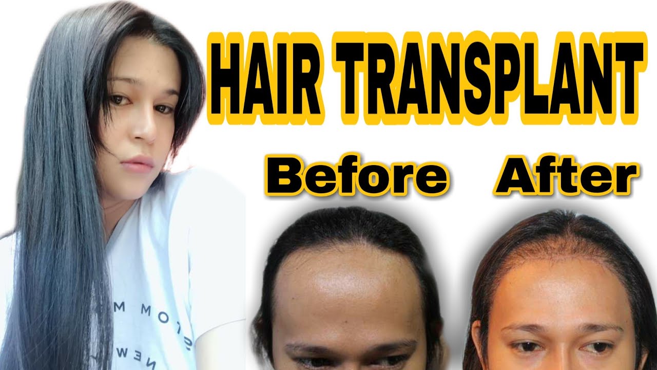 HAIR TRANSPLANT IN THE PHILIPPINES | HAIR TRANSPLANT MANILA REVIEW - YouTube