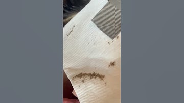 Lice Treatment on a Toddler with 1000s of Lice Eggs l Lice Infestation @staceythelouselady