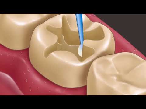 Incredible Teeth 🦷 treatment #asmr #animation #makeover