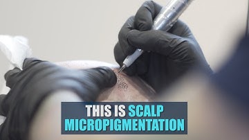 THIS is Scalp Micropigmentation by Hairline Ink