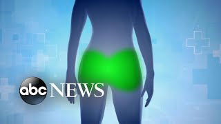 The dark side of illegal buttock injections | Nightline