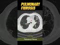 CT CHEST PATHOLOGIES #medicalimaging #radiographer #radiology #radiography #ctscan #radiologia