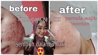 REVIEW 1 BULAN MS GLOW JERAWAT HEMPAS TIPS SUPAYA TIDAK DETOX #msglowacne #acnefighter #reviewmsglow