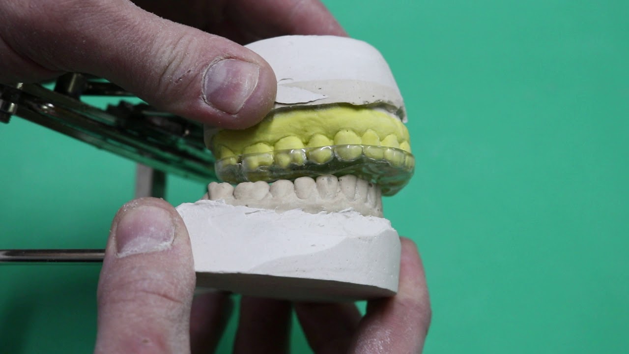 PLACA OCLUSAL: COMO ACERTAR O GUIA CANINO