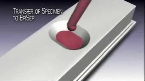 EpiSep Demonstration of Circulating Tumor Cell Isolation