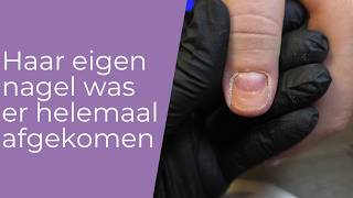 Haar natuurlijke nagel was er helemaal afgekomen