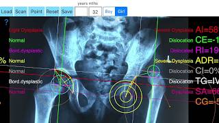 Hip dysplasia App tutorial video how to measure with App in ipad or iphone screenshot 1