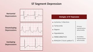 Intro to EKG Interpretation - QRST Changes screenshot 5