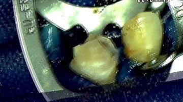 Precurved Protaper Next