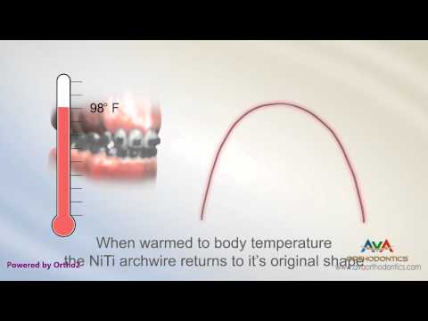 Video NiTi Thermal U (dây cung nhiệt NiTi hàm trên) Ortho Techonology