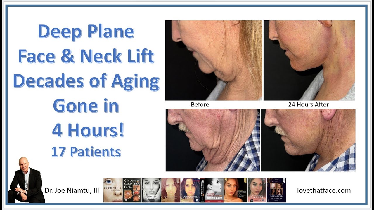 Deep Plane Face & Neck Lift Decades of Aging Gone in 4 Hours YouTube
