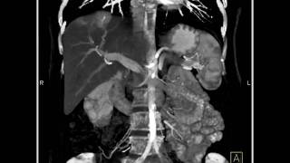 Abdomen Liver Av Malformation Evidence Of A Hypervascular Lesion In The Dome Of The Liver2 Of 5