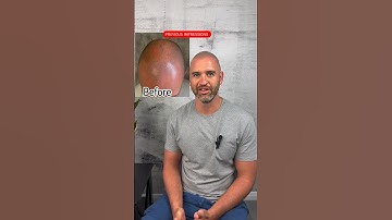 Two Sessions of #scalpmicropigmentation #hairlosstreatment #hair