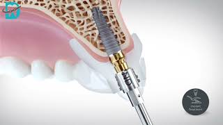 Implant - زراعة الأسنان