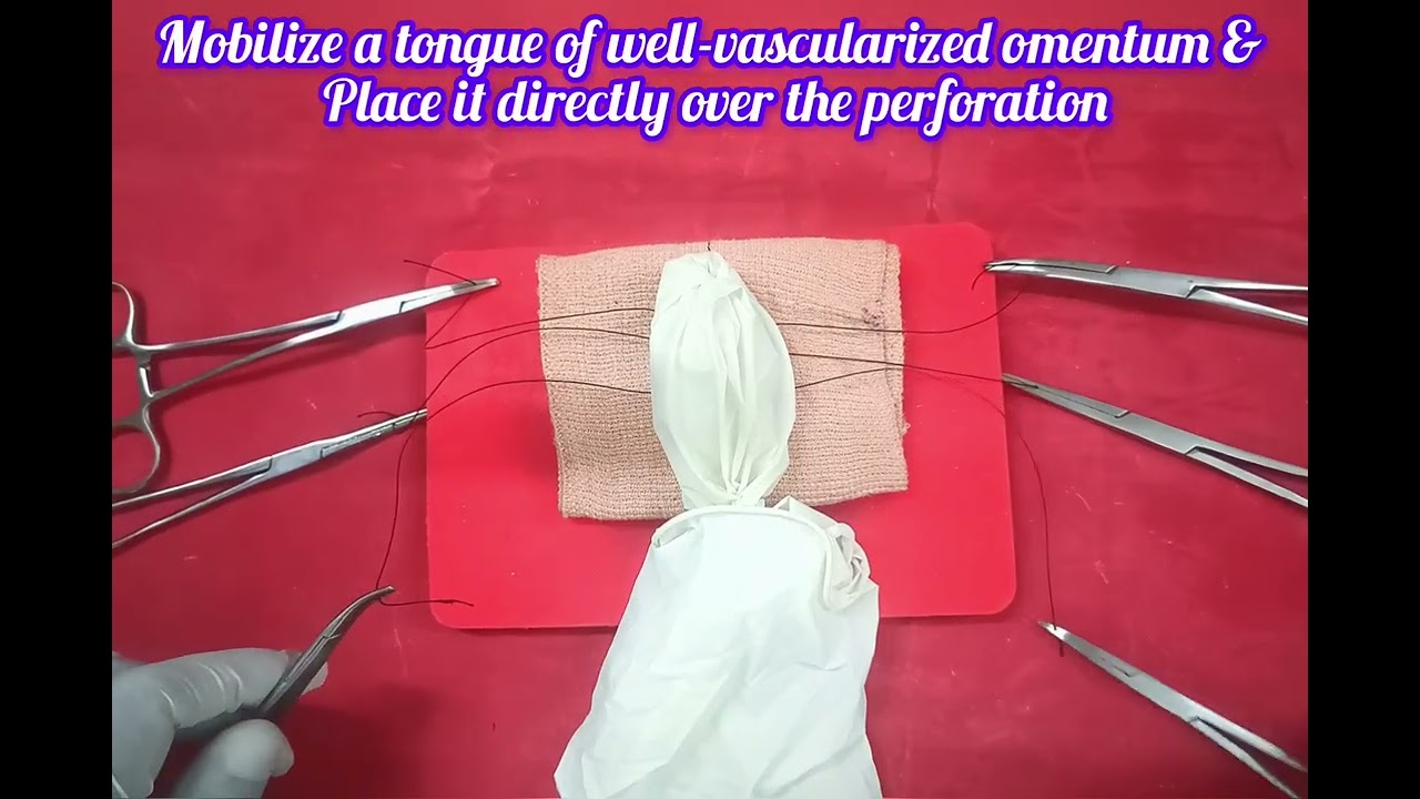 Ремонт Cellan Jones - перфорация двенадцатиперстной кишки