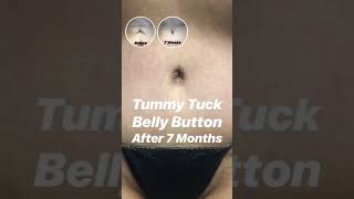 Belly Button | Tummy Tuck | Results | Beverly Hills | Los Angeles | Plastic Surgery Belly Button | Tummy Tuck | Results | Beverly Hills | Los Angeles | Plastic Surgery