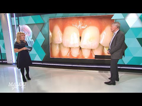 Video: 4 sätt att bli av med sväljna tänder