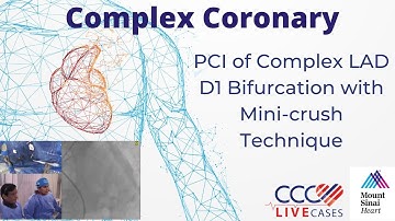 PCI of Complex LAD D1 Bifurcation with Mini-crush Technique