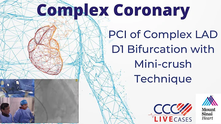 PCI of Complex LAD D1 Bifurcation with Mini-crush Technique