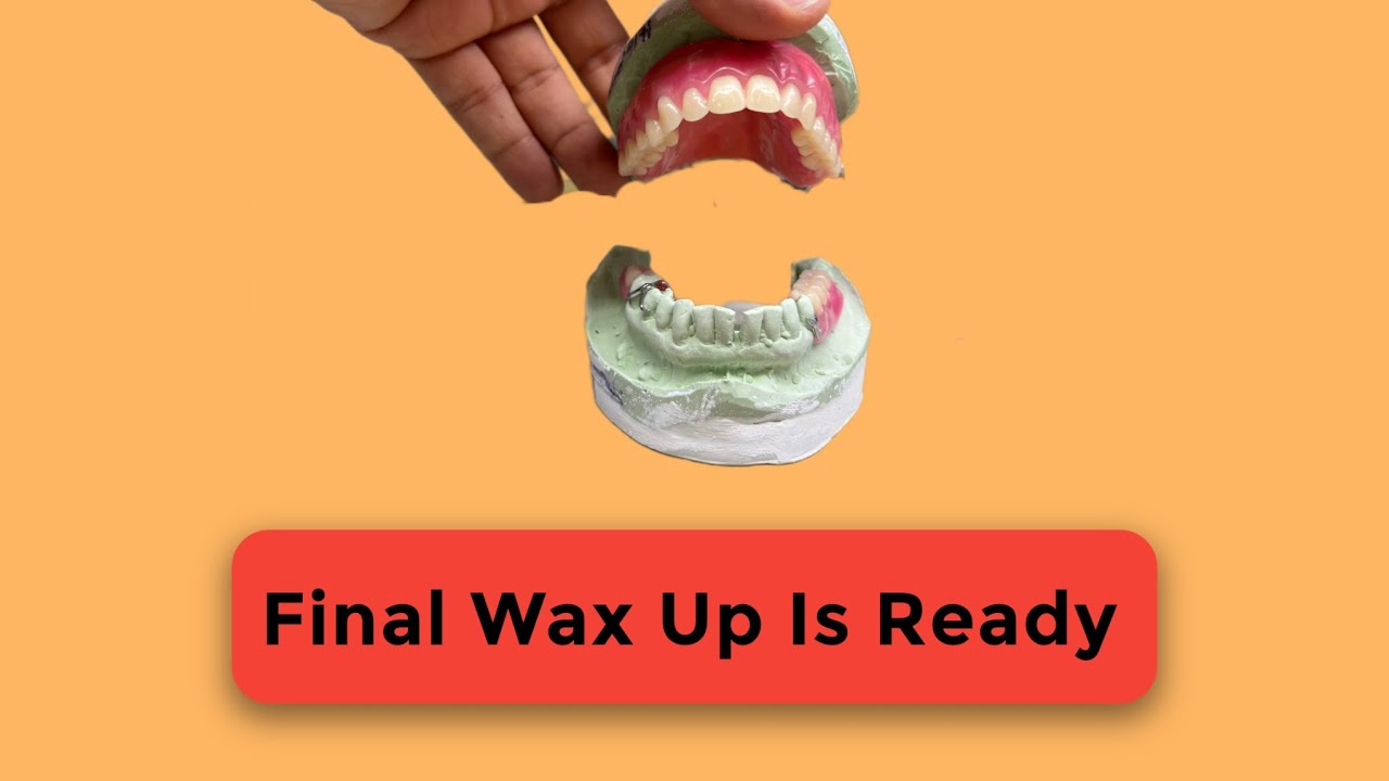 From Start to Final Wax-Up 😍