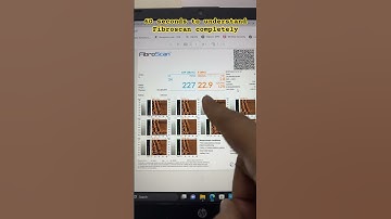 Easiest method (60 seconds) to understand Fibroscan report.