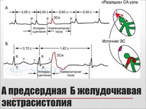 Юрак ритмининг бузилишлари билан булган беморлар курацияси