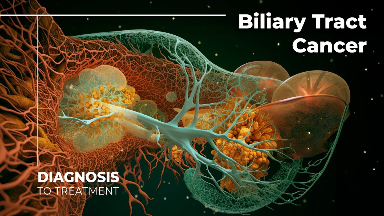 Unveiling the Mysteries of Biliary Tract Cancer: A Deep Dive into Cholangiocarcinoma
