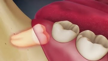 Nhổ răng khôn mọc ngầm như thế nào?