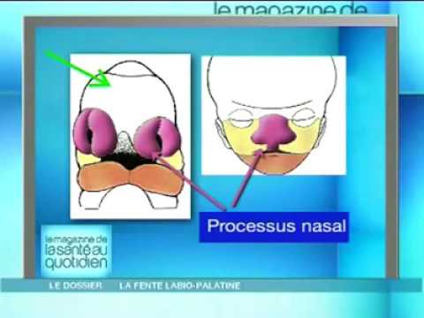 Vidéo: Fente labiale et palatine