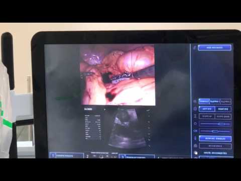 Robotic distal pancreatectomy