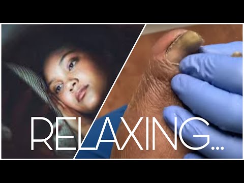 Relaxing Diabetic Toe Nail Cutting