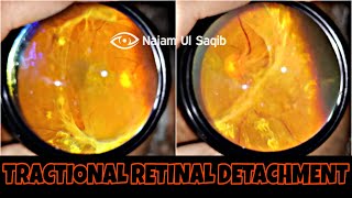 Tractional Retinal Detachment (TRD) In Advanced Diabetic Eye Disease (ADED).