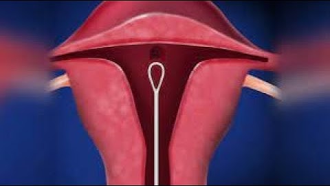 Dilation and Curettage CPT code - simplify medical coding