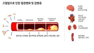 고혈압!!! 당신의 혈관을 위협한다.