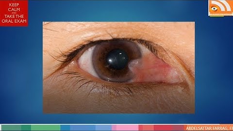 FRCS Viva Exam Simulation Example