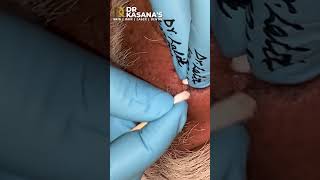 REMOVAL OF 70 YEARS OLD - BLACKHEADS II DR.LALIT KASANA&#39;S