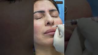 Botox Treatment Procedures #shortsvideo