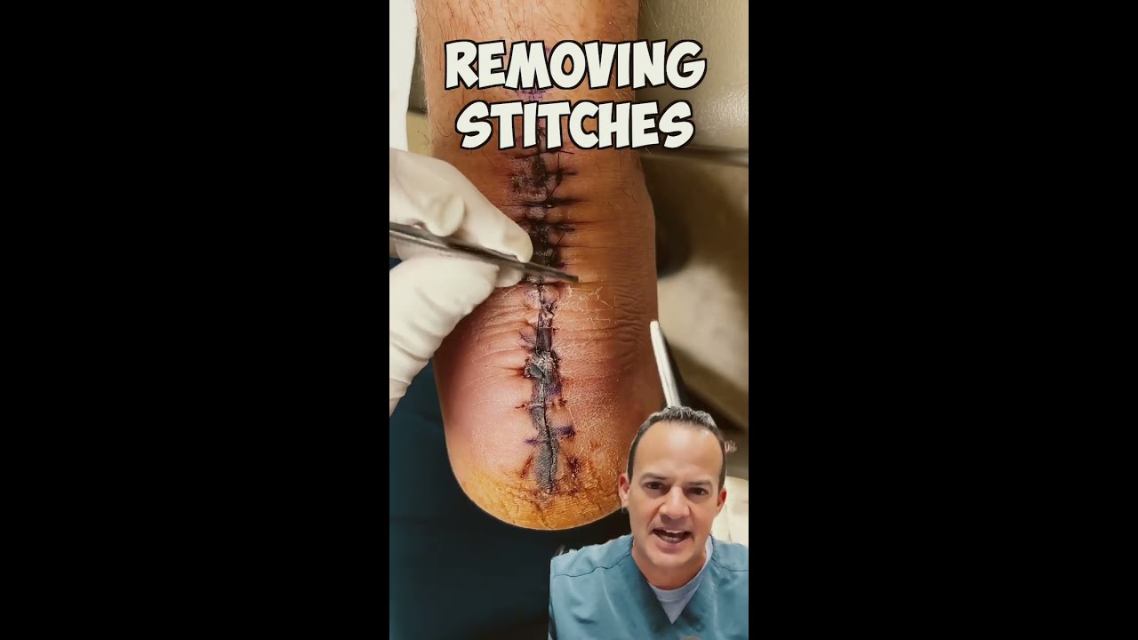 DOCTOR REACTS REMOVING STITCHES Shorts Satisfying