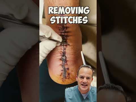 DOCTOR REACTS: REMOVING STITCHES! 😱 #shorts #satisfying