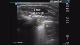 Infant with Bronchiolitis on Lung Ultrasound