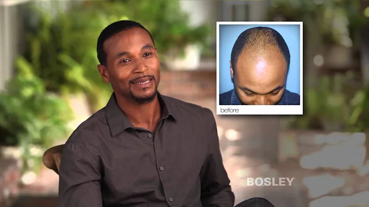 Bosley Hair Restoration Patient Review | Gerald R